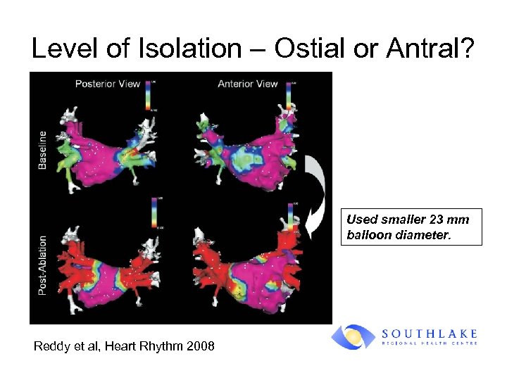 Level of Isolation – Ostial or Antral? Used smaller 23 mm balloon diameter. Reddy