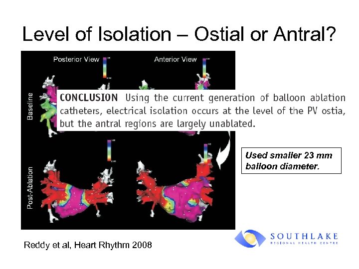 Level of Isolation – Ostial or Antral? Used smaller 23 mm balloon diameter. Reddy