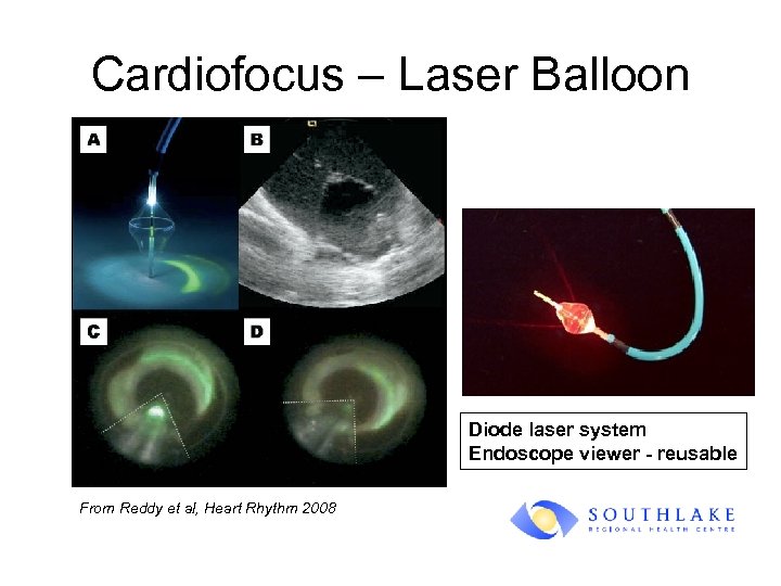 Cardiofocus – Laser Balloon Diode laser system Endoscope viewer - reusable From Reddy et