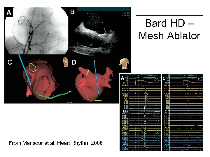 Bard HD – Mesh Ablator From Mansour et al, Heart Rhythm 2008 