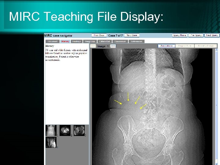MIRC Teaching File Display: 