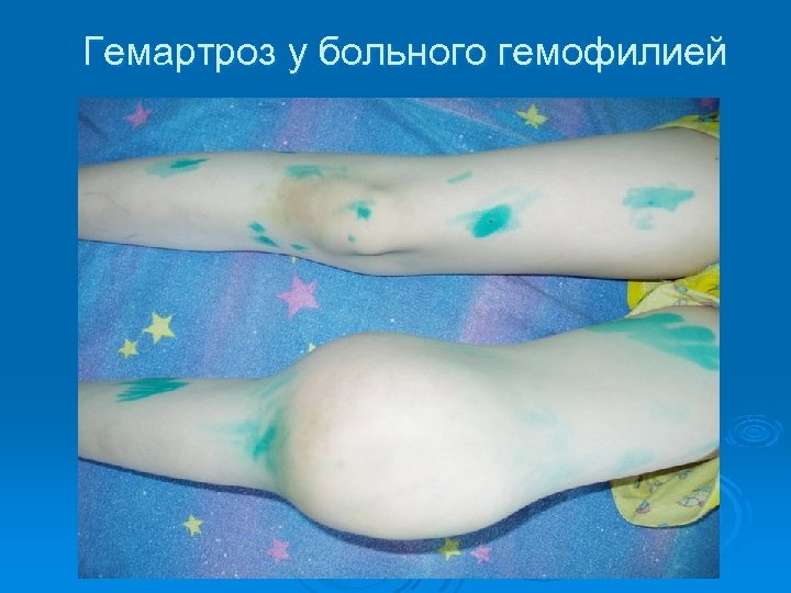Гемартроз у больного гемофилией 