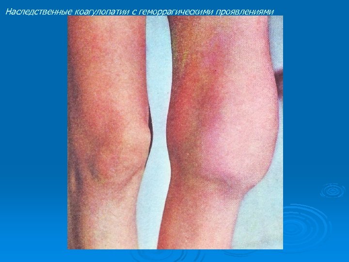 Наследственные коагулопатии с геморрагическими проявлениями 