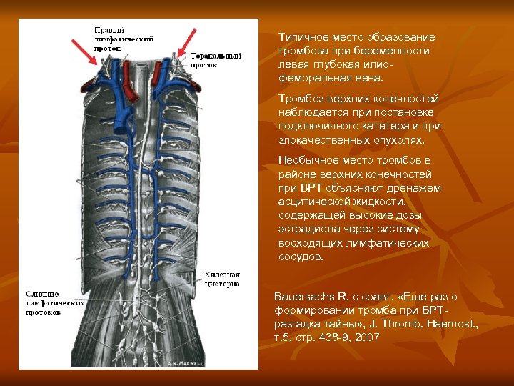 Типичное место образование тромбоза при беременности левая глубокая илиофеморальная вена. Тромбоз верхних конечностей наблюдается
