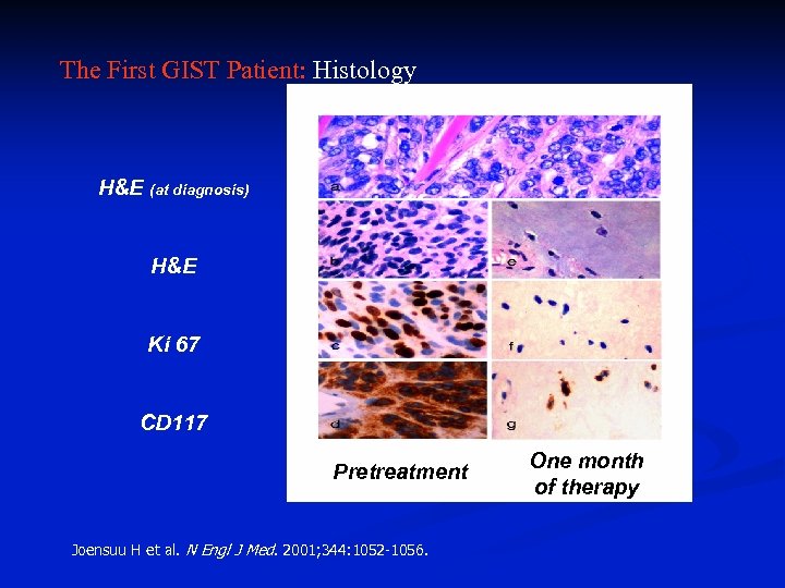 The First GIST Patient: Histology H&E (at diagnosis) H&E Ki 67 CD 117 Pretreatment