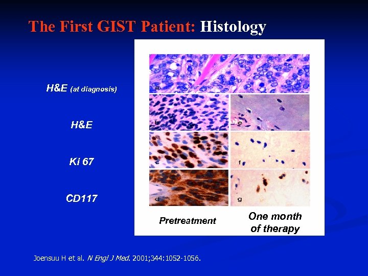 The First GIST Patient: Histology H&E (at diagnosis) H&E Ki 67 CD 117 Pretreatment