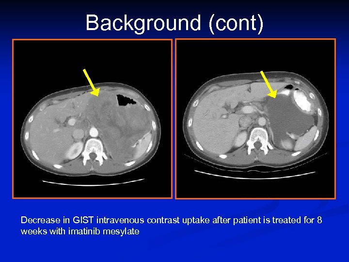 Background (cont) Decrease in GIST intravenous contrast uptake after patient is treated for 8