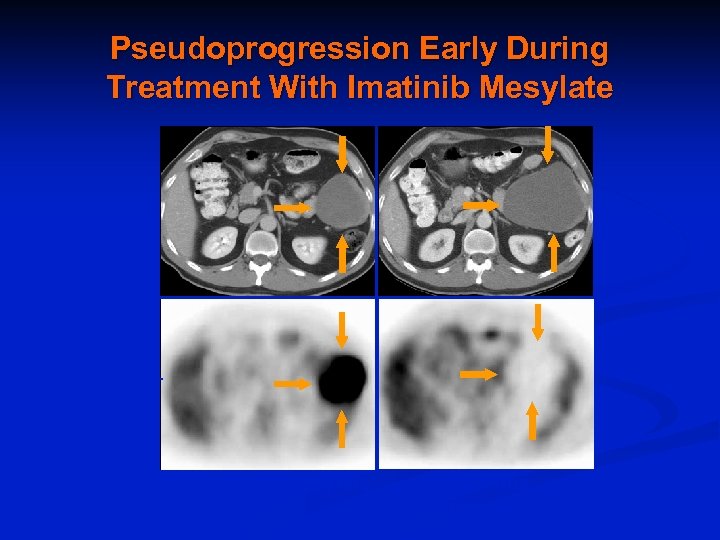 Pseudoprogression Early During Treatment With Imatinib Mesylate CT 18 FDG-PET Pre-imatinib mesylate Choi et