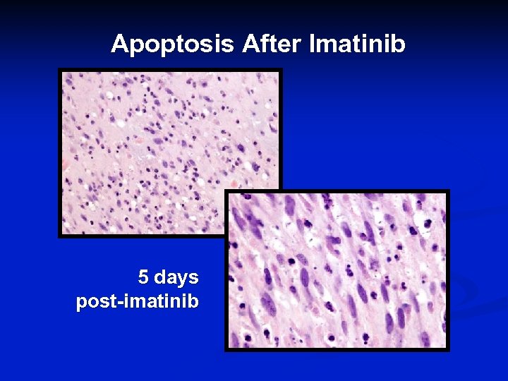Apoptosis After Imatinib 5 days post-imatinib 