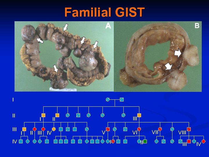 Familial GIST I II III IV III II V VII VI I II VIII