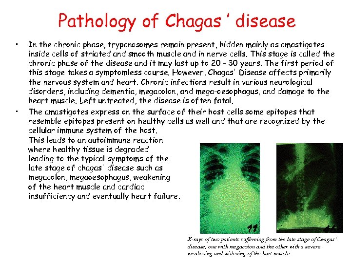 Pathology of Chagas ’ disease • • In the chronic phase, trypanosomes remain present,