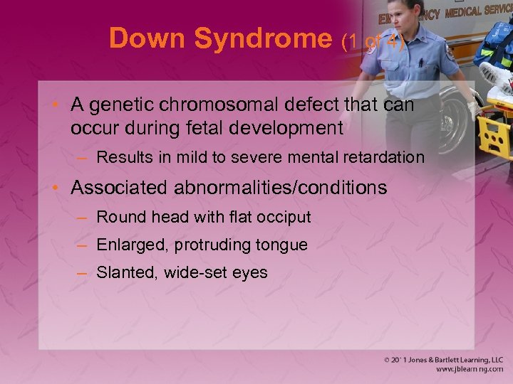 Down Syndrome (1 of 4) • A genetic chromosomal defect that can occur during