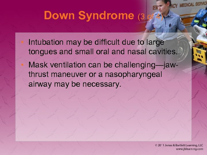 Down Syndrome (3 of 4) • Intubation may be difficult due to large tongues