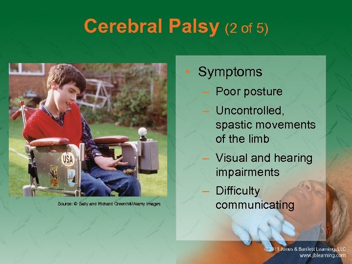 Cerebral Palsy (2 of 5) • Symptoms – Poor posture – Uncontrolled, spastic movements