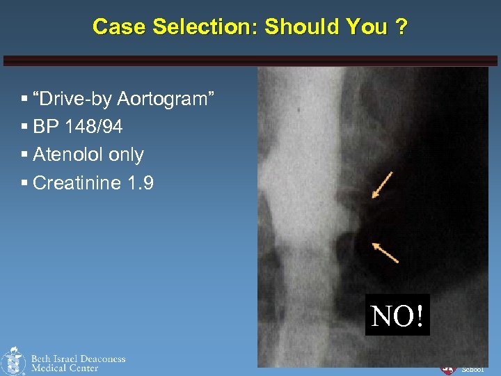 Case Selection: Should You ? § “Drive-by Aortogram” § BP 148/94 § Atenolol only