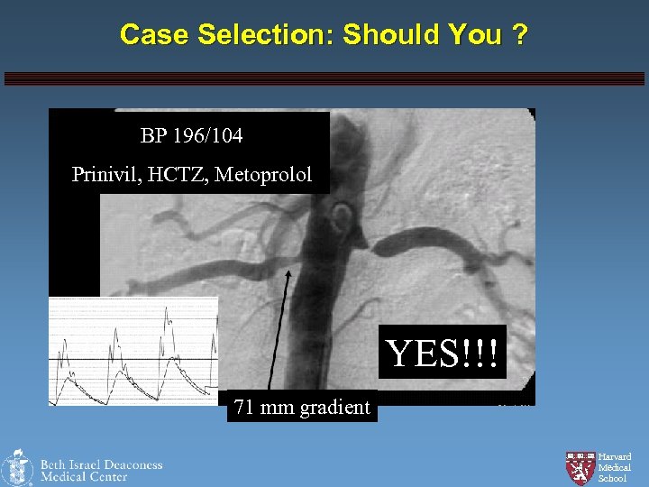 Case Selection: Should You ? BP 196/104 Prinivil, HCTZ, Metoprolol YES!!! 71 mm gradient