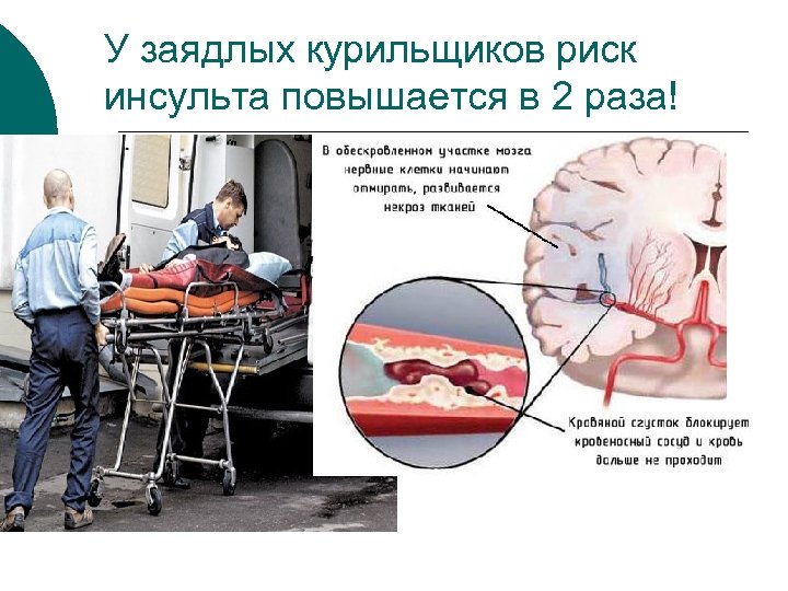 У заядлых курильщиков риск инсульта повышается в 2 раза! 