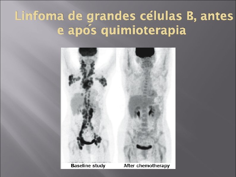 Linfoma de grandes células B, antes e após quimioterapia 