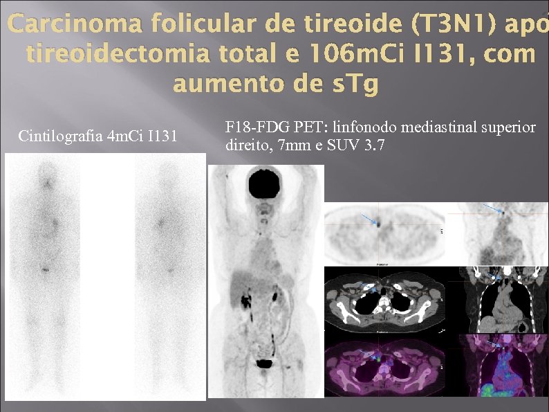 Carcinoma folicular de tireoide (T 3 N 1) apó tireoidectomia total e 106 m.