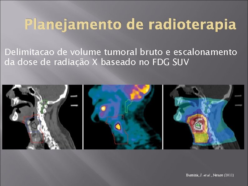 Planejamento de radioterapia Delimitacao de volume tumoral bruto e escalonamento da dose de radiação