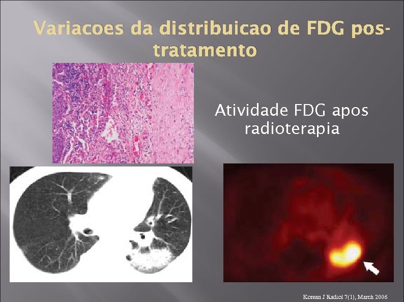 Variacoes da distribuicao de FDG postratamento Atividade FDG apos radioterapia Korean J Radiol 7(1),