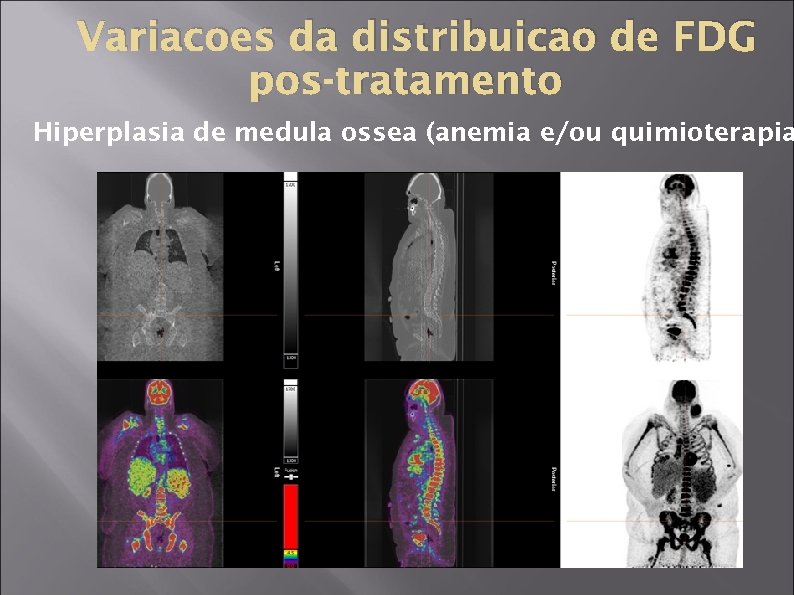 Variacoes da distribuicao de FDG pos-tratamento Hiperplasia de medula ossea (anemia e/ou quimioterapia 