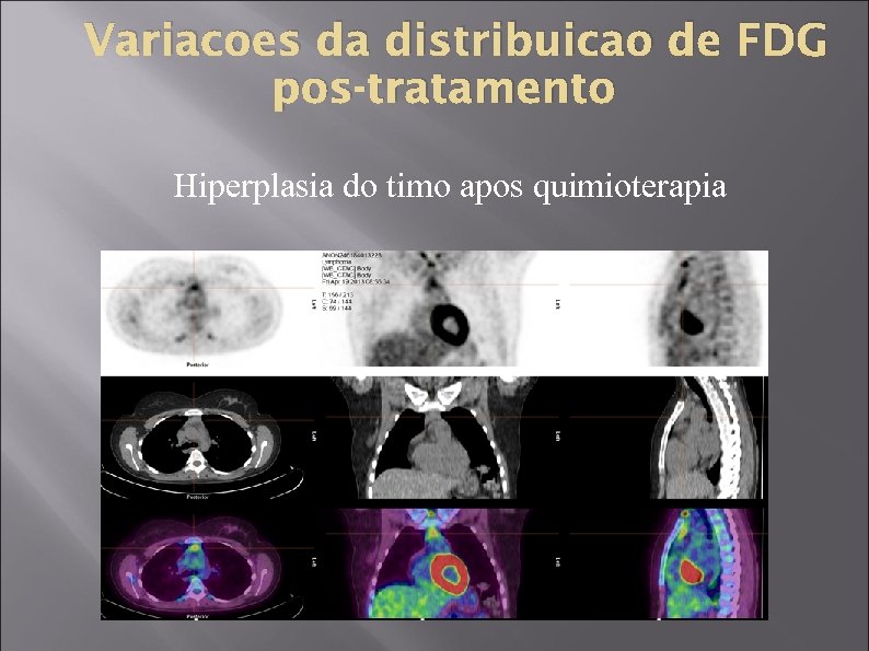 Variacoes da distribuicao de FDG pos-tratamento Hiperplasia do timo apos quimioterapia 