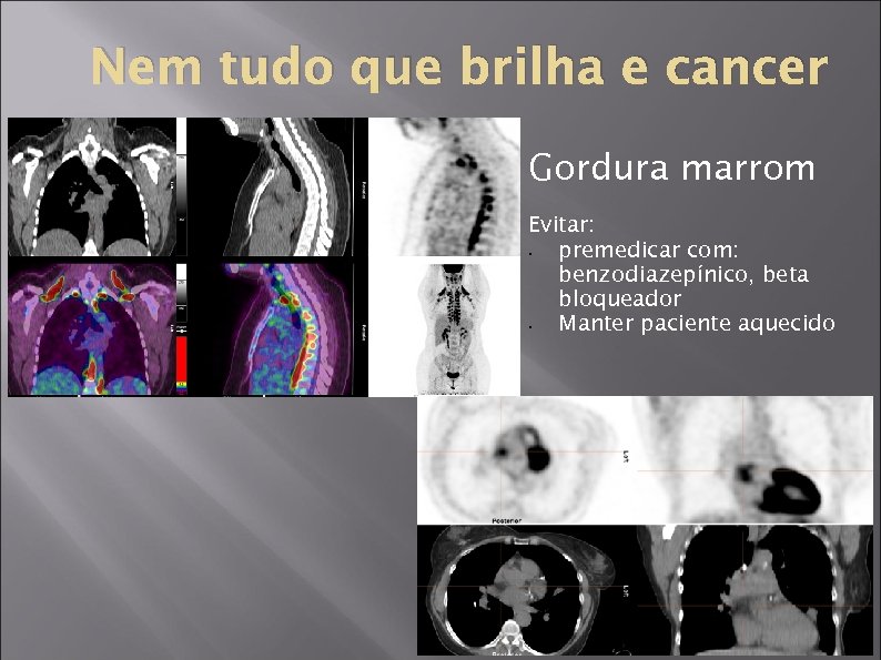 Nem tudo que brilha e cancer Gordura marrom Evitar: • premedicar com: benzodiazepínico, beta