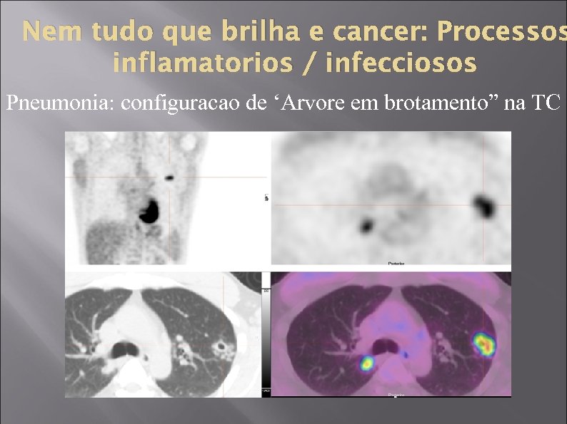 Nem tudo que brilha e cancer: Processos inflamatorios / infecciosos Pneumonia: configuracao de ‘Arvore