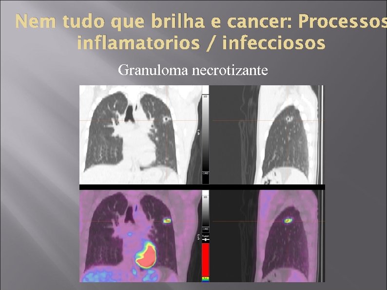 Nem tudo que brilha e cancer: Processos inflamatorios / infecciosos Granuloma necrotizante 