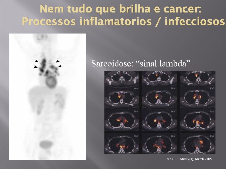 Nem tudo que brilha e cancer: Processos inflamatorios / infecciosos Sarcoidose: “sinal lambda” Korean