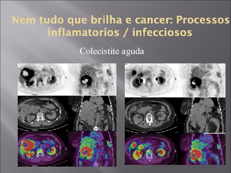 Nem tudo que brilha e cancer: Processos inflamatorios / infecciosos Colecistite aguda 