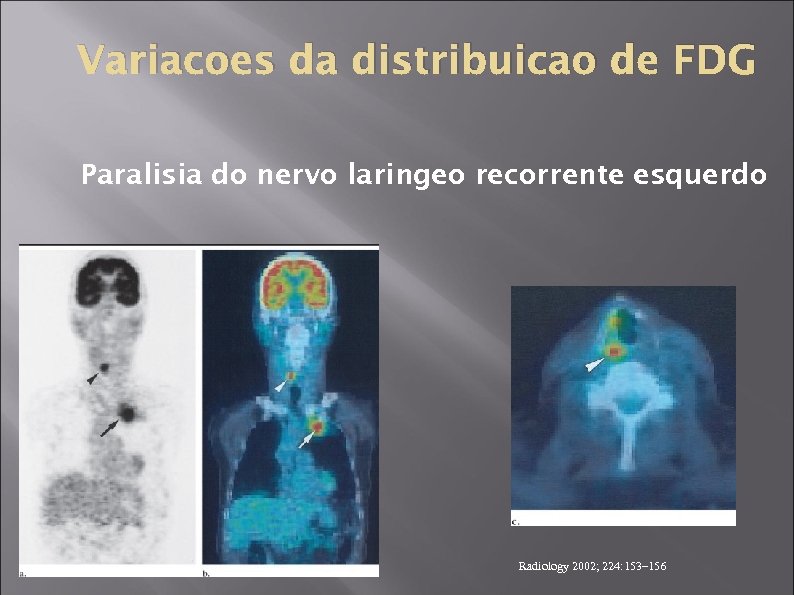 Variacoes da distribuicao de FDG Paralisia do nervo laringeo recorrente esquerdo Radiology 2002; 224: