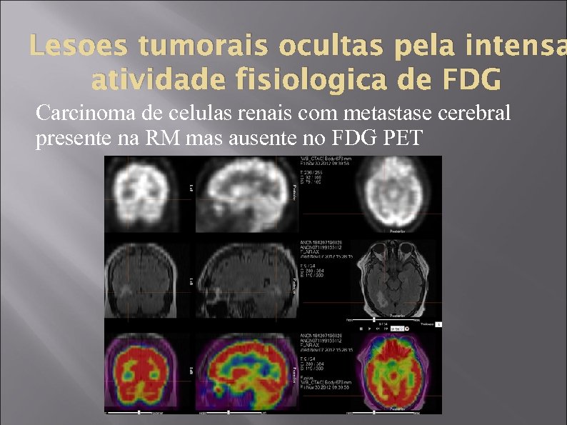 Lesoes tumorais ocultas pela intensa atividade fisiologica de FDG Carcinoma de celulas renais com