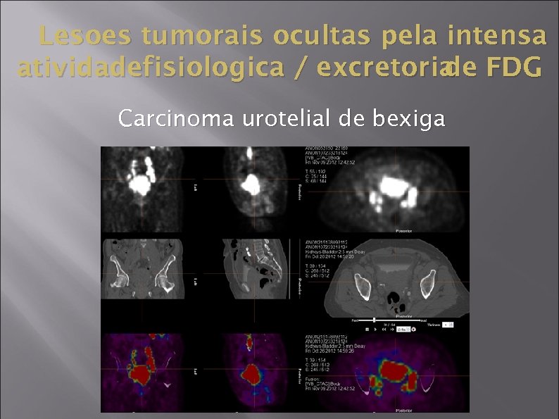 Lesoes tumorais ocultas pela intensa atividadefisiologica / excretoria FDG de Carcinoma urotelial de bexiga