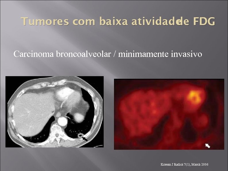 Tumores com baixa atividade FDG de Carcinoma broncoalveolar / minimamente invasivo Korean J Radiol