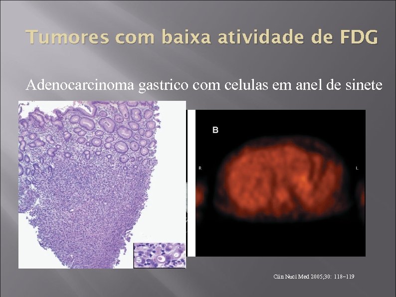 Tumores com baixa atividade de FDG Adenocarcinoma gastrico com celulas em anel de sinete