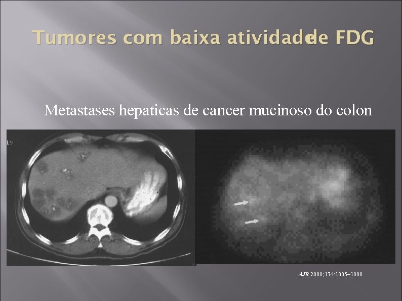 Tumores com baixa atividade FDG de Metastases hepaticas de cancer mucinoso do colon AJR