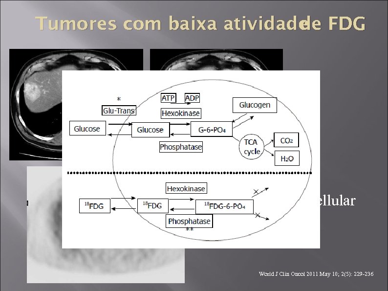 Tumores com baixa atividade FDG de Carcinoma hepatocellular bem diferenciado World J Clin Oncol