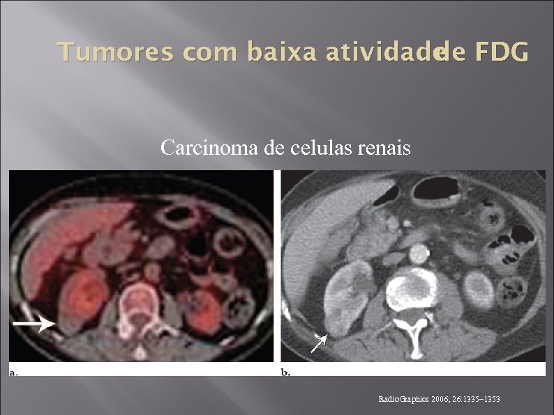 Tumores com baixa atividade FDG de Carcinoma de celulas renais Radio. Graphics 2006; 26: