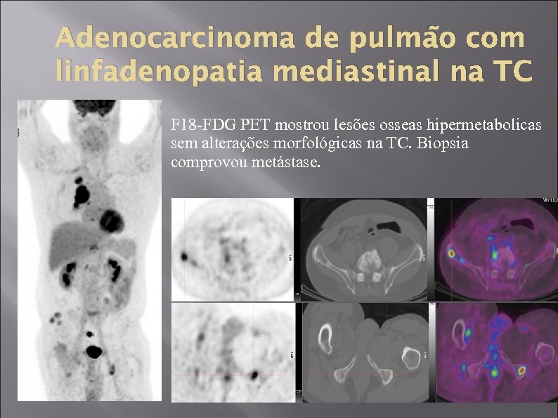 Adenocarcinoma de pulmão com linfadenopatia mediastinal na TC F 18 -FDG PET mostrou lesões