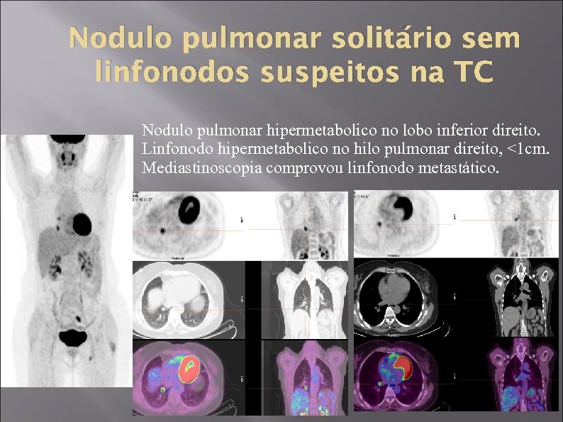 Nodulo pulmonar solitário sem linfonodos suspeitos na TC Nodulo pulmonar hipermetabolico no lobo inferior