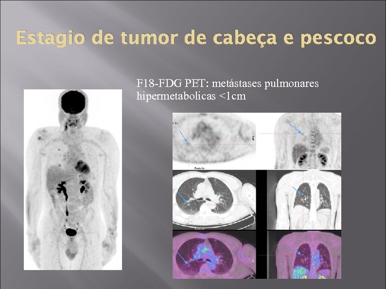 Estagio de tumor de cabeça e pescoco F 18 -FDG PET: metástases pulmonares hipermetabolicas