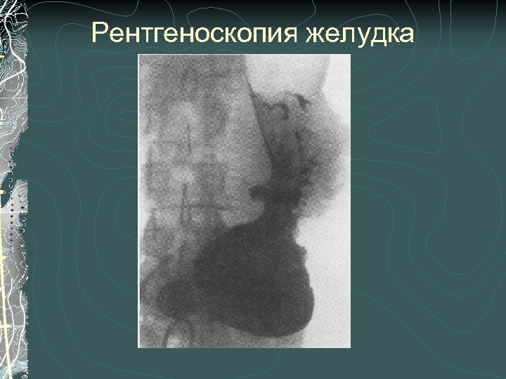 Рентгеноскопия желудка 