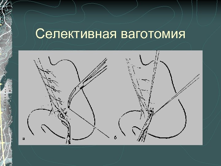 Селективная ваготомия 