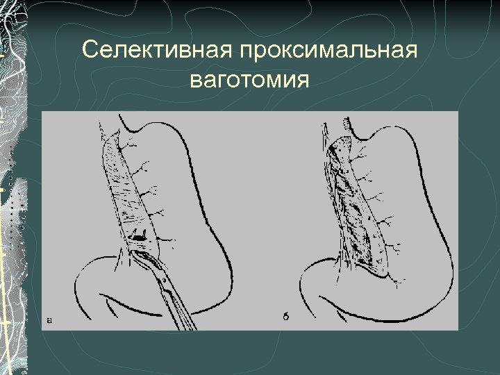 Селективная проксимальная ваготомия 