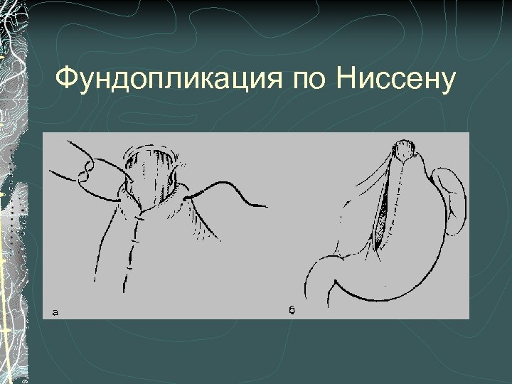 Фундопликация по Ниссену 