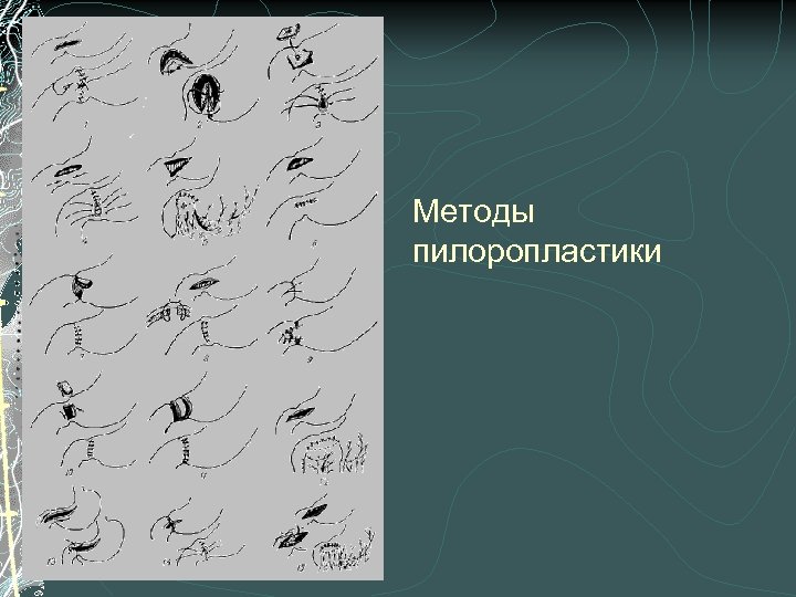 Методы пилоропластики 