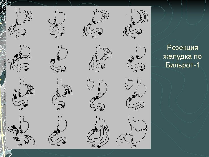 Резекция желудка по Бильрот-1 