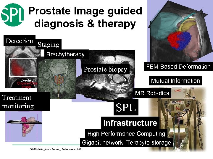 Prostate Image guided diagnosis & therapy Detection Staging Brachytherapy FEM Based Deformation Prostate biopsy